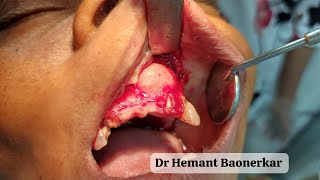 Odontogenic Keratocyst Surgery Dr Hemant Baonerkar Mumbai 9004290977 [upl. by Zina460]