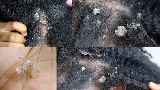 My Seborrheic Dermatitis my scalp up close [upl. by Aihsia]