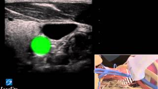 3D Comment Insertion échoguidée dun Cathéter en Jugulaire Interne Long  échographe SonoSite [upl. by Aicnetroh]