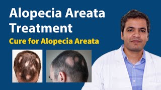 Alopecia Areata Symptoms Causes and Treatment  Alopecia Hair Growth  Cure for Alopecia [upl. by Jarad]