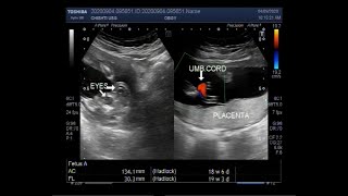 Ultrasound Video showing Anencephaly with a pregnancy of about 19 weeks [upl. by Namwob]