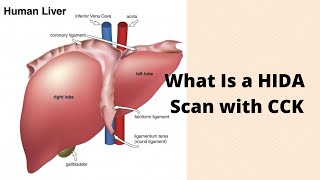 Hepatobiliary Scintigraphy HIDA Scan [upl. by Zetroc]