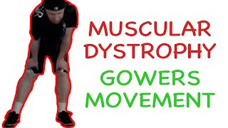 Muscular Dystrophy Gowers Maneuver [upl. by Gosnell]