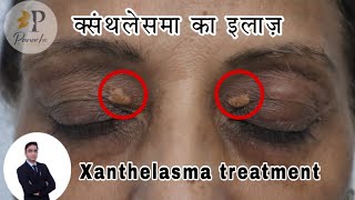 Xanthelasma Surgery in Delhi  Xanthelasma Treatment  Xanthelasma Removal  xanthelasma [upl. by Dennie]