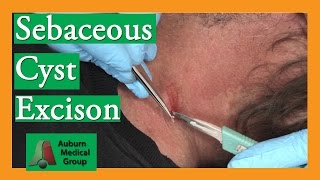 Sebaceous Cyst Removal  Auburn Medical Group [upl. by Robbyn]