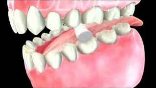 Root CanalDental [upl. by Ancier]