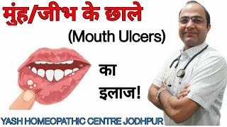 मुँह के छाले का ईलाज । Mouth tongue lips ulcer homeopathic treatment ।best treatment।home remedy [upl. by Bayless]