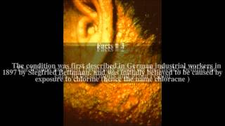 Chloracne Top  5 Facts [upl. by Ahseer]