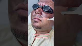 Carbon Laser ￼Facial getsmarthairclub skintreatment shorts shortvideo shortsfeed [upl. by Anemix]