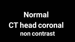 Normal CT headNon contrastCoronal [upl. by Ardnuhsor748]