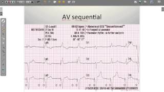 ECG Paced Rhythms [upl. by Freiman564]