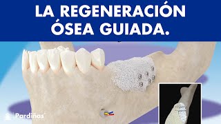 Regeneración ósea guiada  ¿Se pueden colocar implantes dentales sin tener hueso © [upl. by Aronek]