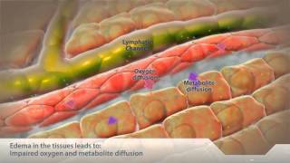 Consequences of Fluid Overload  Tissues [upl. by Auhsuoj605]