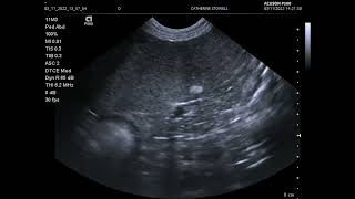 Ultrasound scan showing calcified nodule in the canine spleen [upl. by Angel145]