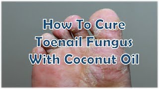 How To Cure Toenail Fungus With Coconut Oil [upl. by Eleanora]