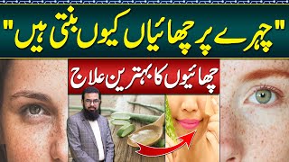 Melasma Treatment at Home  Melasma Cream and Melasma Home Remedies  Face Par Chaiyan Ka Ilaj [upl. by Drazze244]