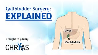 Gallbladder Surgery Explained [upl. by Afaw]