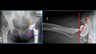 Acetabular Component Position in Total Hip Replacement [upl. by Airetnuhs779]