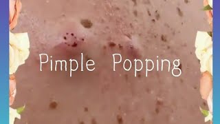 Pimple amp Blackheads Popping  39 [upl. by Aenehs46]