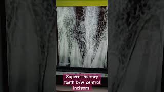 supernumerary teeth bw central incisors dentalcafe4331 [upl. by Hseyaj]