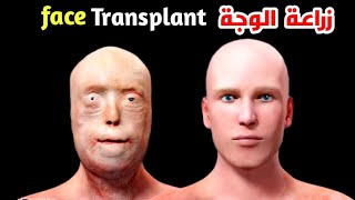 شاهد كيف تتم عملية زراعة الوجة بعد الحروق والحوادثFace transplant surgery after burns [upl. by Ettenoitna]