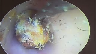 Hard cerumen embolism cleaning earwax Cleaning earwaxremoval satisfying [upl. by Hesta917]