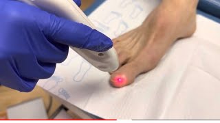 Laser Toenail Therapy For Nail Fungus  Arlington Foot and Ankle [upl. by Araiet]