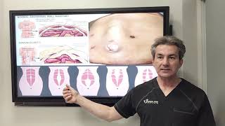 What is diastasis of rectus muscles by Dr Iraniha [upl. by Melesa]