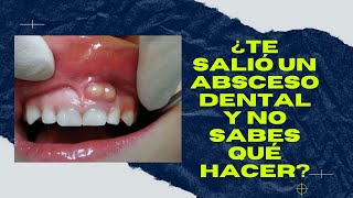 ABSCESO DENTAL ¿Qué es y cómo eliminarlo [upl. by Kemble654]