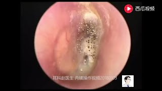 Earwax Removal ExtractionCerumen airtight 13 minutes [upl. by Nohtanoj540]