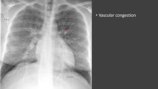 Pulmonary Edema [upl. by Hafeetal]