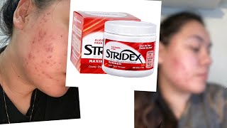 ONE MONTH USING STRIDEX PADS FOR MY ACNE [upl. by Ezarras]