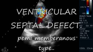 VSDPeri membranus Type ECHOCARDIOGRAPHY SERIES BY DR ANKUR K CHAUDHARI [upl. by Anaiad]