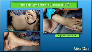 HenochSchonlein PurpuraHSP  Clinical features  Pathophysiology  Diagnosis and Treatment [upl. by Naig]