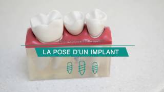 Tout savoir sur la pose dimplant [upl. by Sueddaht327]