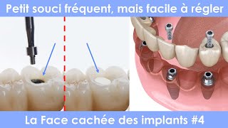 La face cachée des implants dentaires  4  Perdre un plombage composite qui cache le système vissé [upl. by Eedrahs]