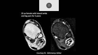 MRI of the Ankle Part 6 – Ankle Tendons [upl. by Janaye148]