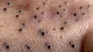 Blackheads Removal Big Acne blackheads Extraction Whiteheads [upl. by Sophy]