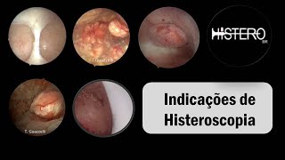 Histeroscopia Indicações da técnica [upl. by Ezitram]