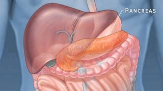 Pancreatic Auto Islet Transplantation with Total Pancreatectomy [upl. by Cindelyn915]