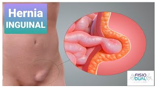 Ejercicios para Hernia Inguinal [upl. by Erida]