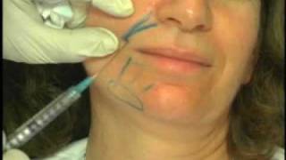 Sculptra Procedure Demonstration by Dr Mest  Part 1 [upl. by Becker]