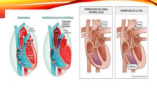 22 Cardiopathies Congénitales Dr Benlalam Parnet  Cardio [upl. by Easlehc855]