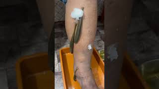 Can leeches remove blood clots leechtherapyswellingvaricoseveinspainskinskincarelegpaindr [upl. by Notla]