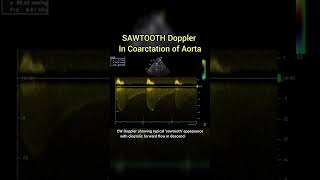 Sawtooth Doppler of Coarctation of Aorta on Echocardiography cardiology [upl. by Thagard935]