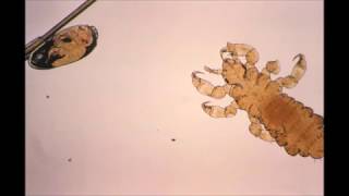 Pediculosis Head and body lice [upl. by Nrehtak]