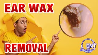 EAR WAX REMOVAL  Causes Of Earwax Buildup Ep37 [upl. by Mychal]