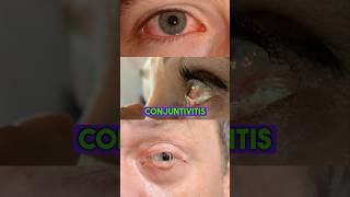 Síntomas de la conjuntivitis salud conjuntivitis oftalmologia ojos drwilsondelgado viralshort [upl. by Polito137]