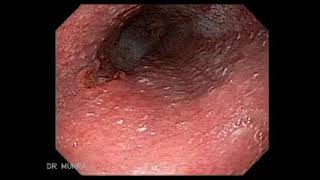 Esofagitis infecciosa por Citomegalovirus [upl. by Thgirw]