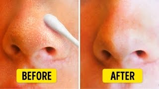 Satisfying and relaxing blackhead removal 2024  Pimples Removal home remedies  Blackheads [upl. by Bruno]